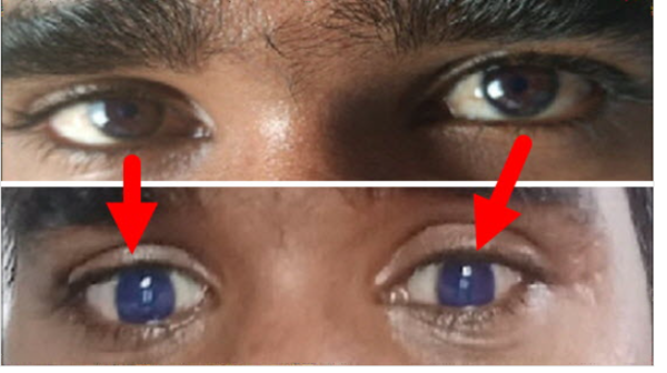 ⓒ데일리포스트=이미지 제공/Indian Journal of Ophthalmology