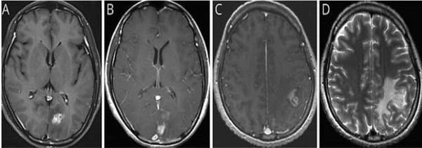 [예시] (A) 초기 뇌 MRI에서 좌측 후두엽에 조영증강된 종괴가 관찰됨 (B) 3개월 뒤 시행한 뇌 MRI에서 좌측 후두엽의 종괴가 사라짐 (C) 8개월 뒤 시행한 뇌 MRI에서 좌측 두정엽에 새롭게 조영증강된 종괴가 발견됨 (D) 좌측 두정엽 종괴 주변에 심한 뇌부종이 동반된 모습이 확인됐다. / 서울대병원제공