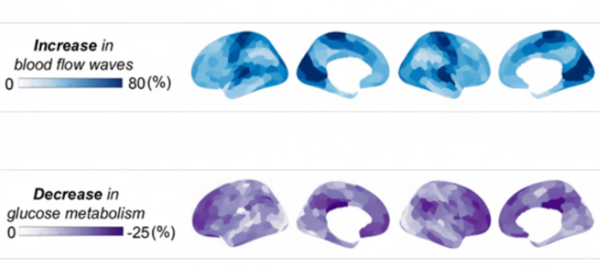 수면 중 뇌의 혈류 변화와 포도당 대사 감소. 파란색은 혈류의 진폭이 커진 부위, 보라색은 포도당 대사가 감소한 부위를 나타낸다. ⓒ데일리포스트=이미지 제공/Nature Communications
