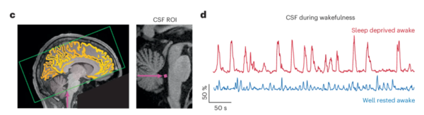 수면 부족 상태(빨간색)에서 깨어 있는 동안에도 뇌척수액(CSF) 파동이 나타나는 모습을 보여주는 실험 결과. ⓒ데일리포스트=이미지 제공/Neuroscience